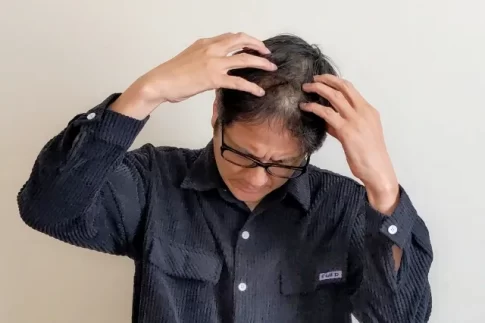 薄毛　男性