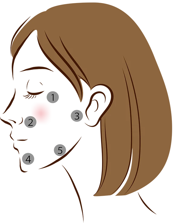 Five injection points on one side of the face
