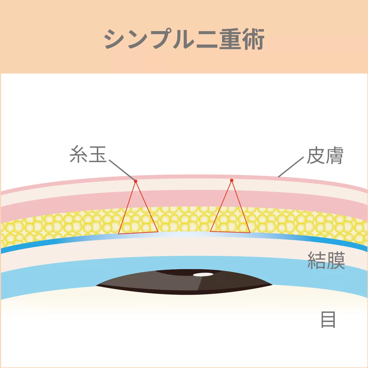 Simple Double Eyelid Surgery