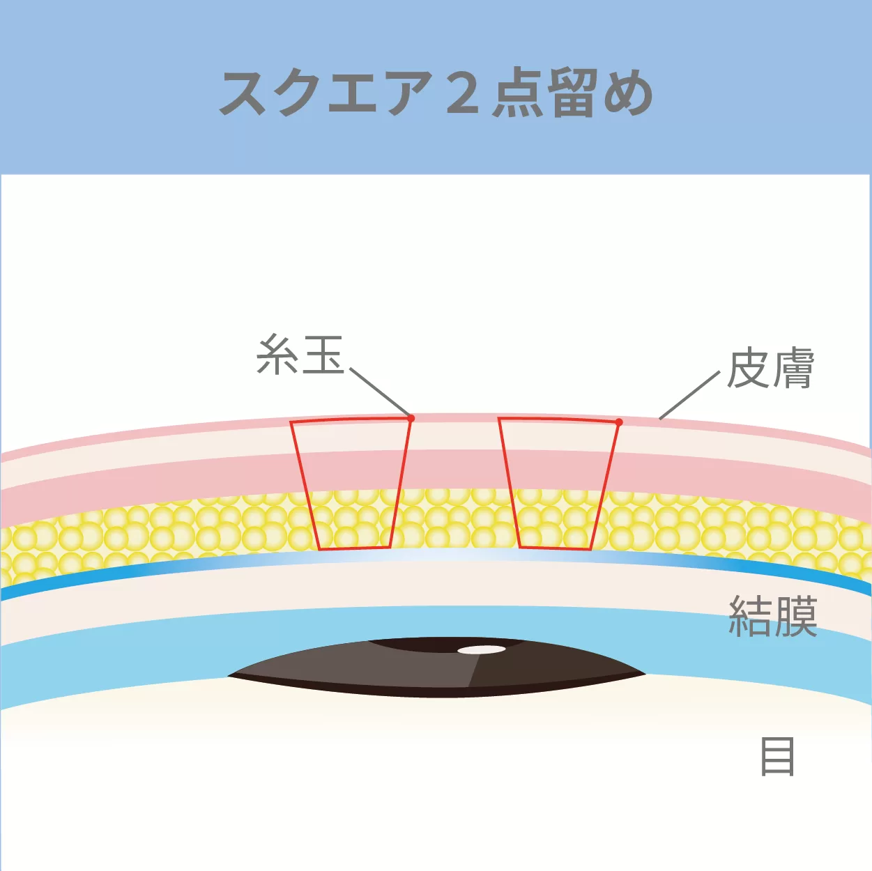 Square 2-Point Fixation