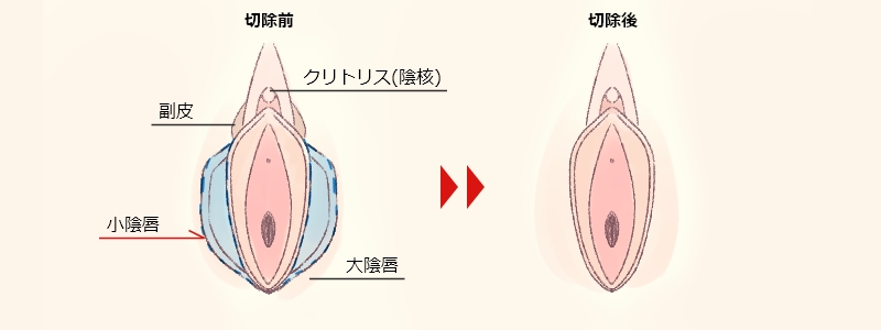 小陰唇切除前と後