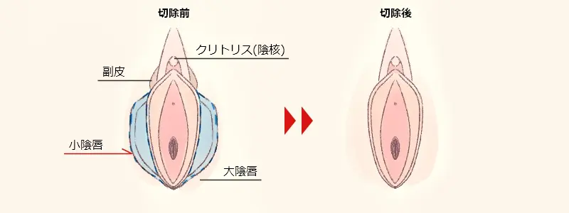小陰唇切除前と後