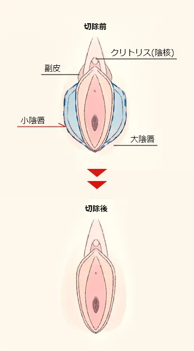 小陰唇切除前と後