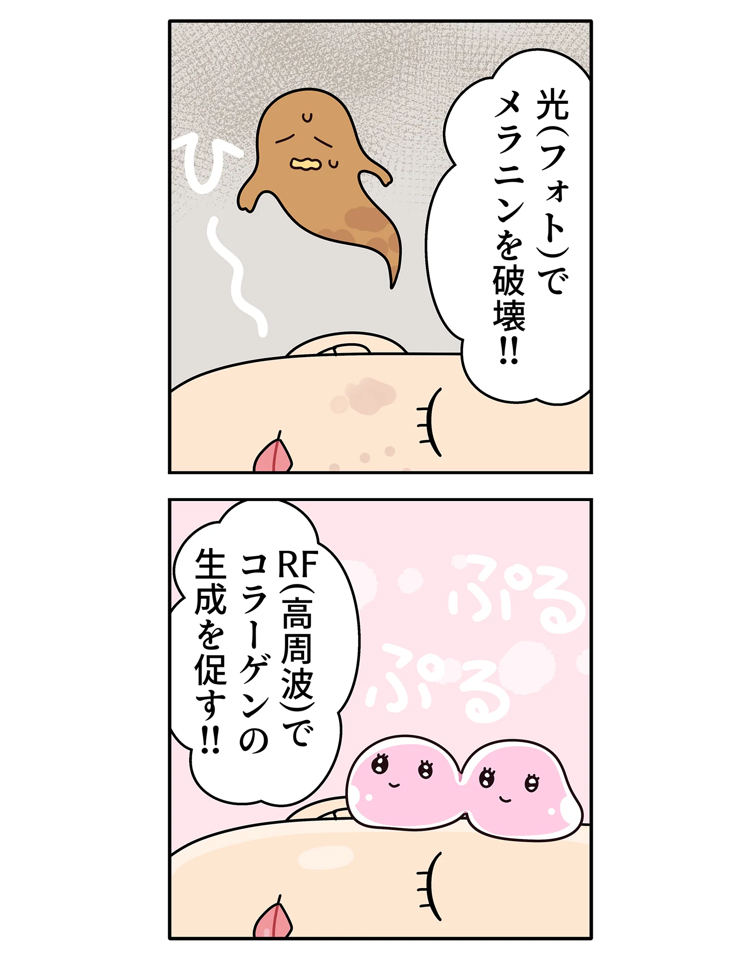光谱RF（IPL 光疗法）