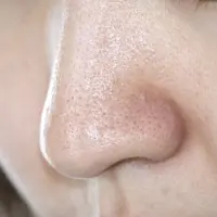 毛穴 黒ずみ
