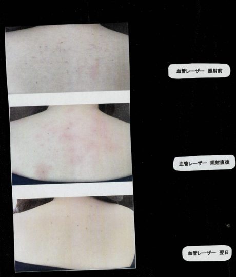 血管レーザー照射前・照射直後・翌日の経過症例写真