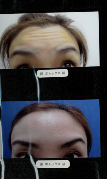 額へのボツリヌストキシン注射の施術前後の症例写真