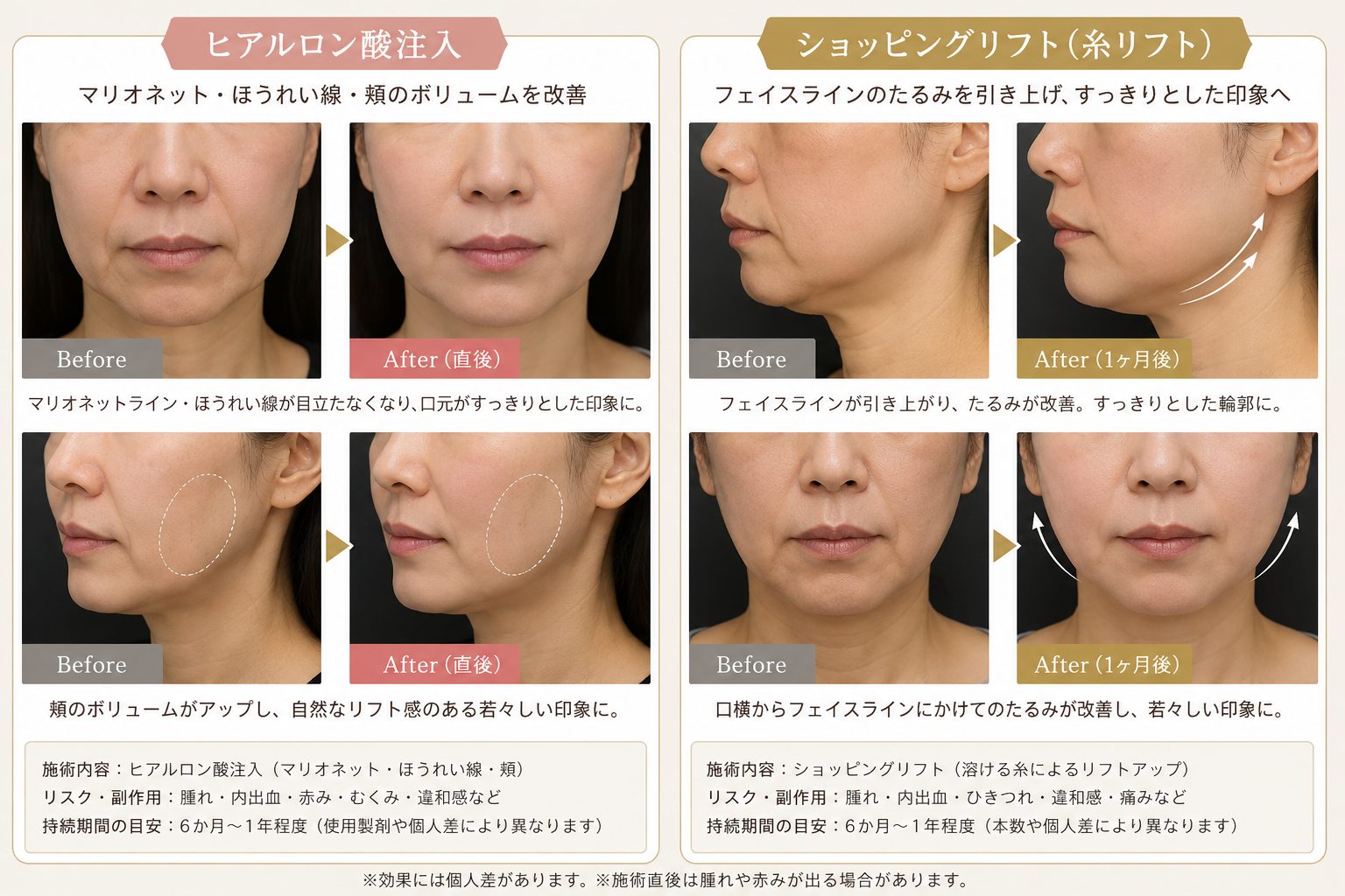 ヒアルロン酸注入とショッピングスレッド(糸リフト)併用施術の前後の症例写真