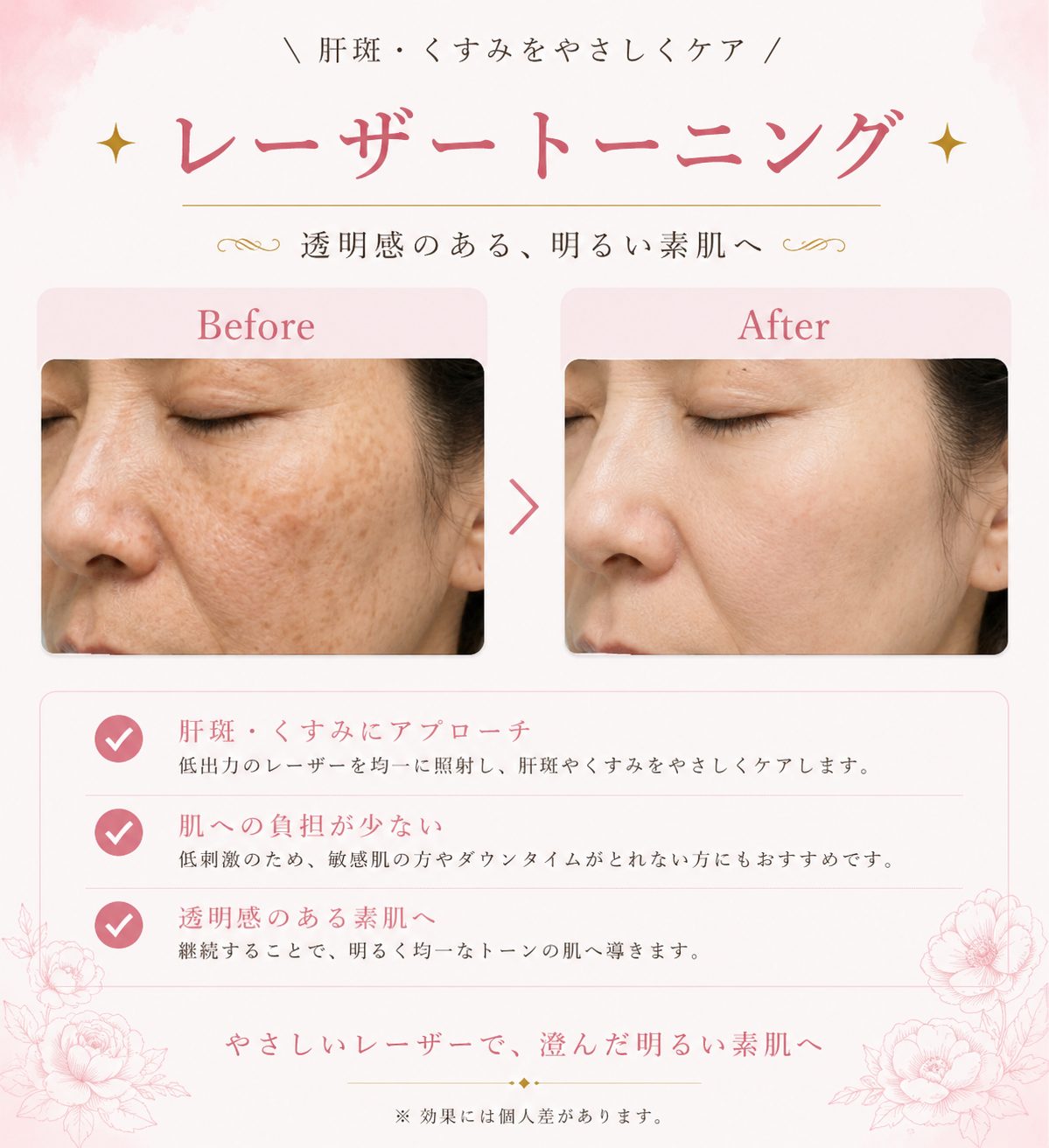 レーザートーニング施術前後の症例写真。肝斑・くすみの改善例