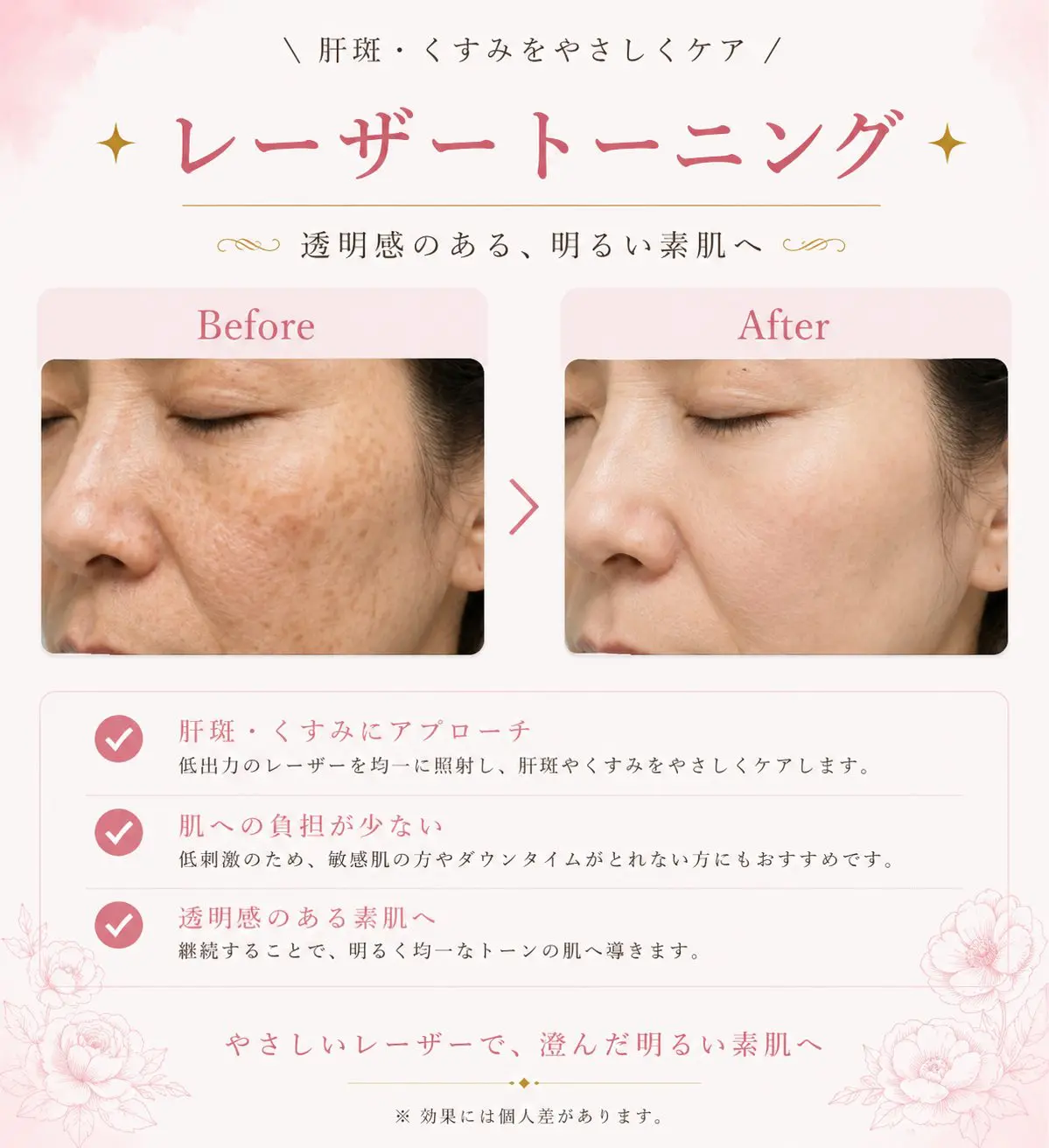 レーザートーニング施術前後の症例写真。肝斑・くすみの改善例