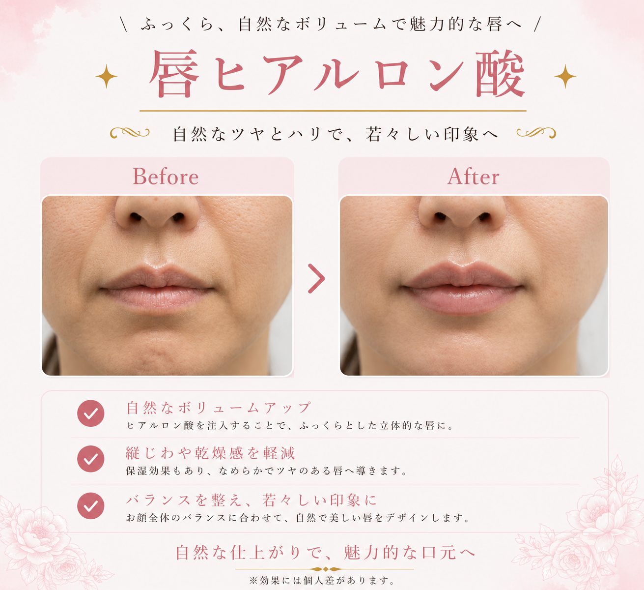 唇へのヒアルロン酸注入の施術前後の症例写真