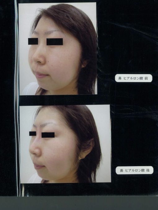 鼻へのヒアルロン酸注入の施術前後の症例写真