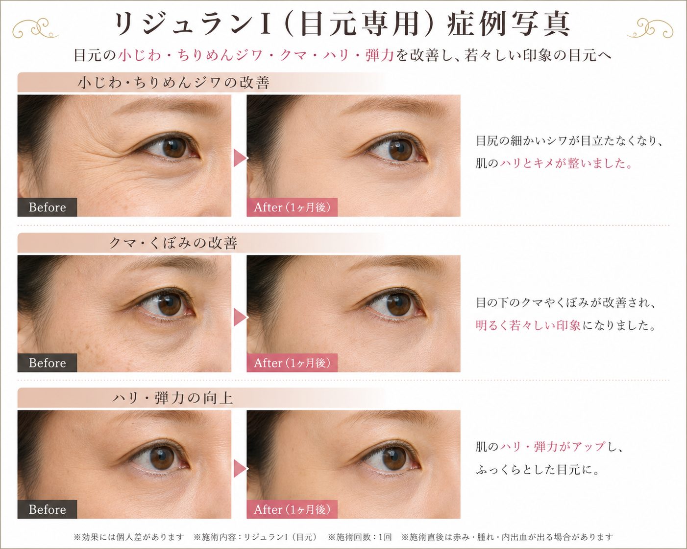 リジュランI（目元専用）施術前後の症例写真。小じわ・クマ・ハリ不足の改善例