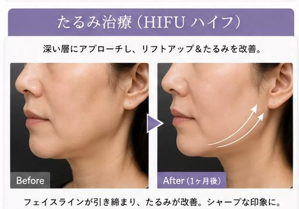 たるみ治療(HIFU ハイフ)の施術前後の症例写真