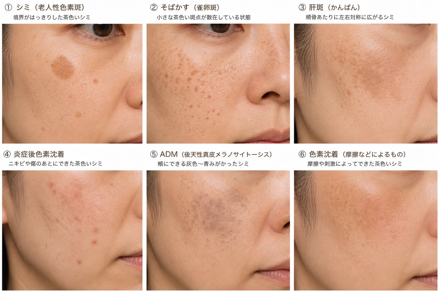 しみ | 川口市の美容皮膚科・美容外科 ヒロクリニック | しみ