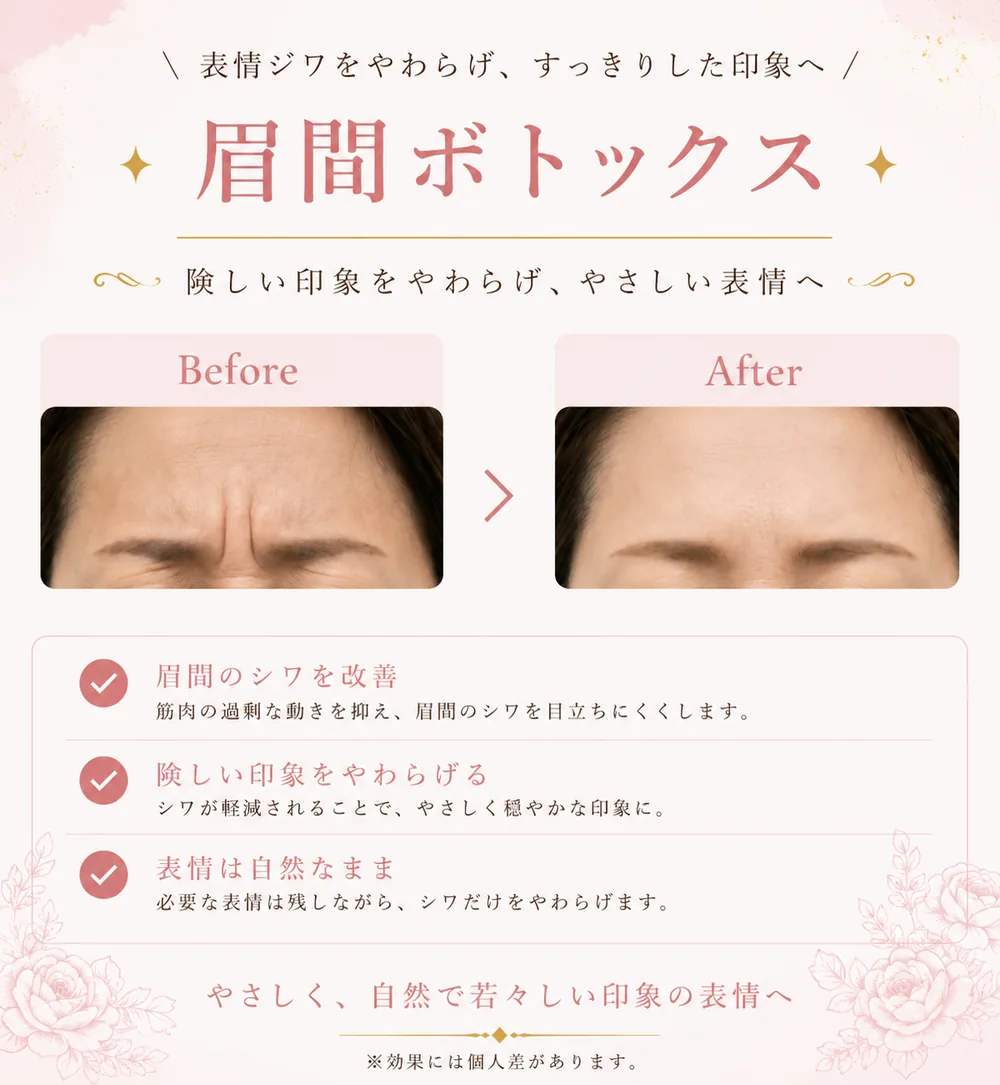 ボツリヌストキシン注射の症例写真（眉間のしわ）｜ヒロクリニック美容皮膚科