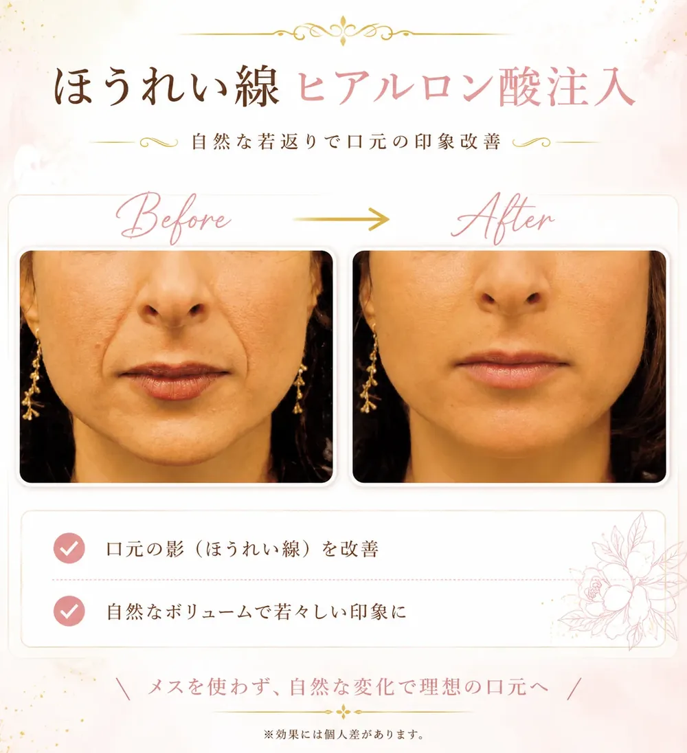 ヒアルロン酸注入の症例写真（ほうれい線）｜ヒロクリニック美容皮膚科