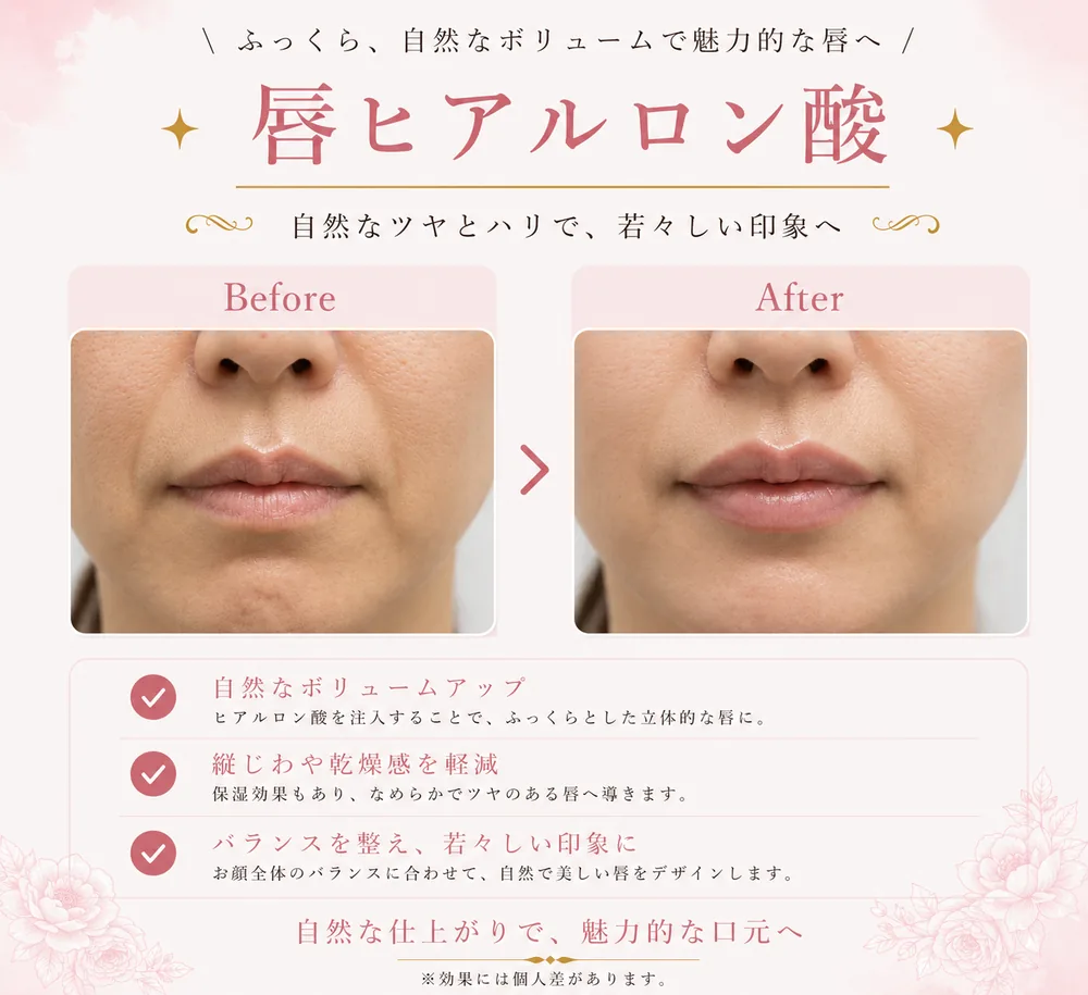 ヒアルロン酸注入の症例写真（唇（0.2〜0.4cc使用））｜ヒロクリニック美容皮膚科