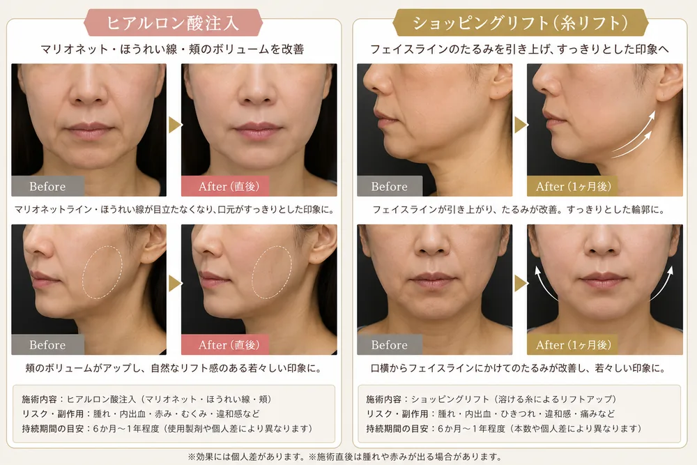ヒアルロン酸注入の症例写真（マリオネット・ほうれい線・頬（1か月後））｜ヒロクリニック美容皮膚科