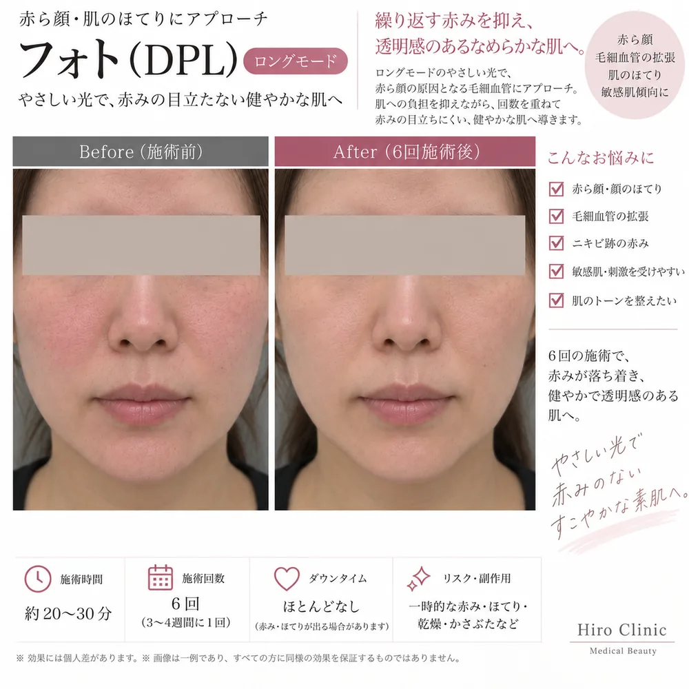 フォトRF（DPL光治療）の症例写真（赤ら顔・ほてり（6回施術後））｜ヒロクリニック美容皮膚科
