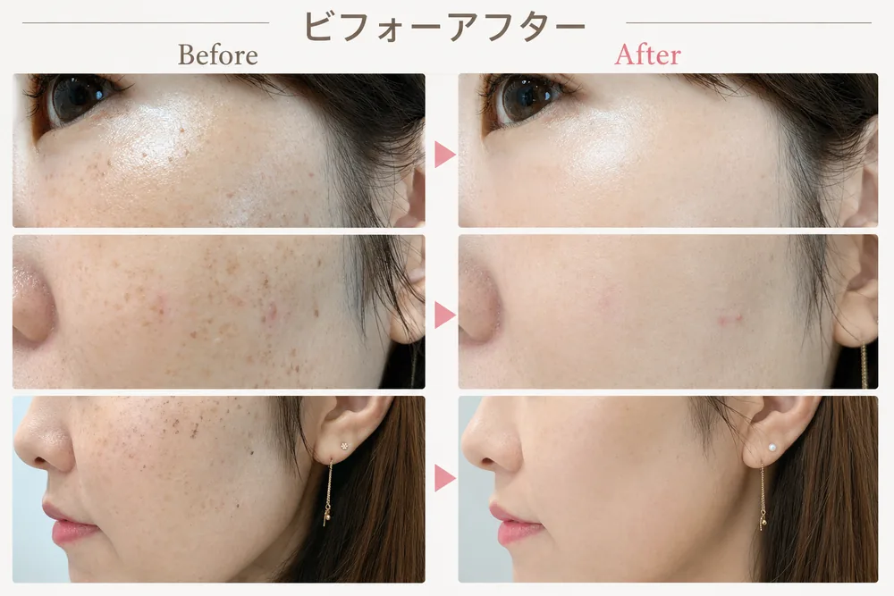 フォトRF（IPL光治療）の症例写真（しみ・肌あれ）｜ヒロクリニック美容皮膚科