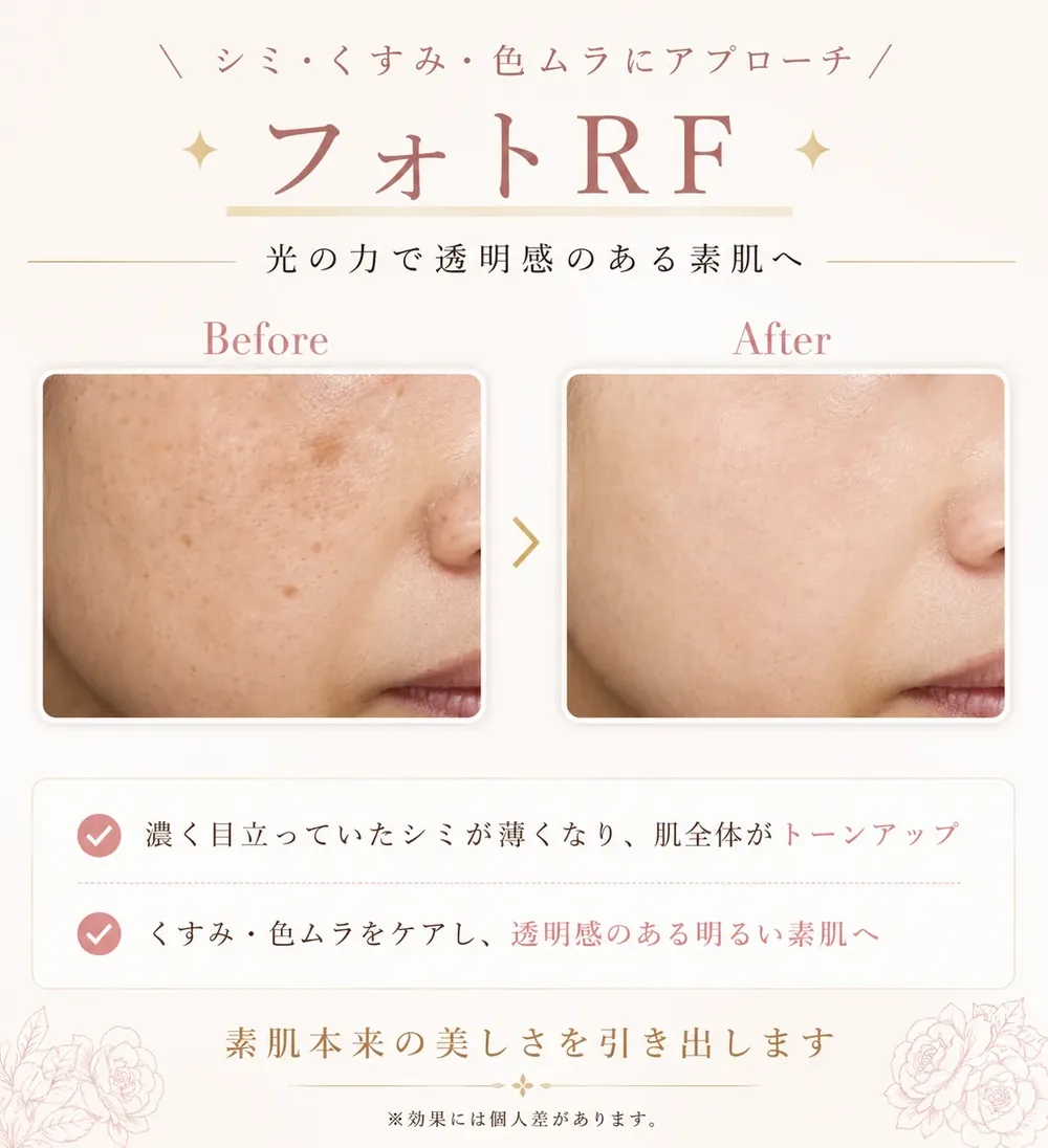フォトRF（IPL光治療）の症例写真（肌のトーン）｜ヒロクリニック美容皮膚科