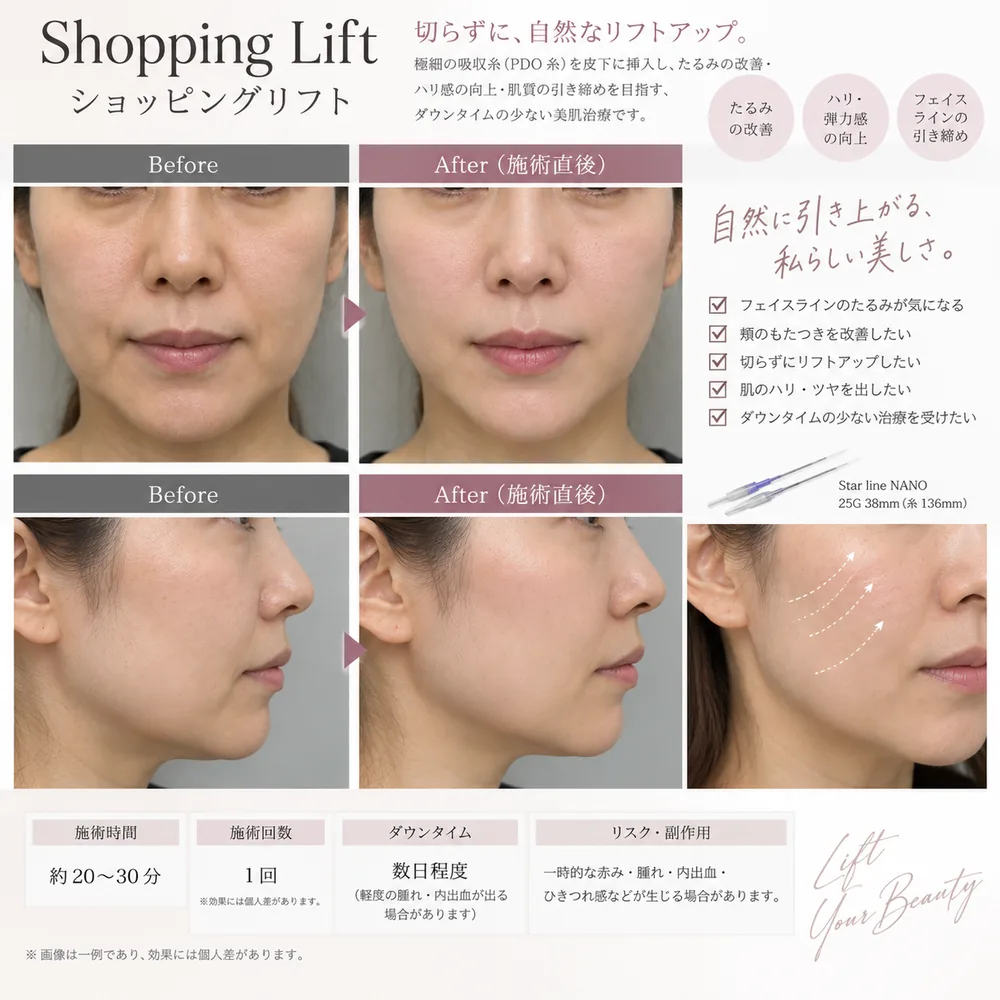 ショッピングスレッド（10本）の症例写真（たるみ（施術直後））｜ヒロクリニック美容皮膚科