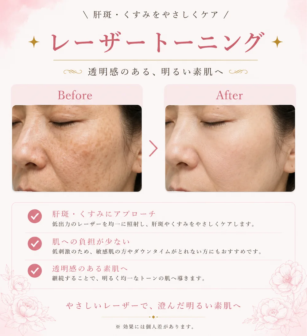 レーザートーニングの症例写真（肝斑・くすみ）｜ヒロクリニック美容皮膚科