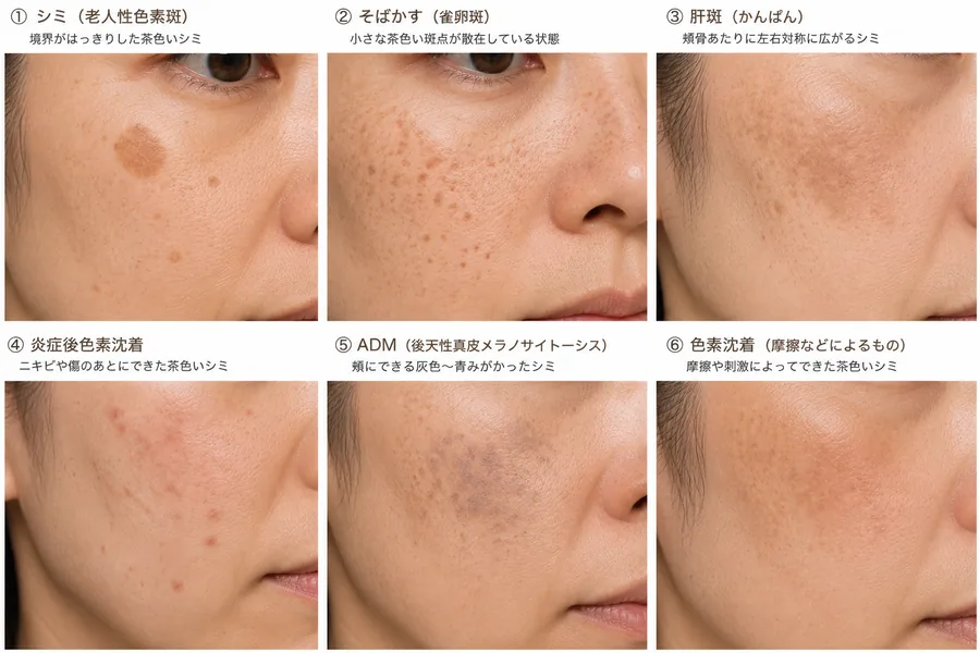 しみ（複数の種類）の見本画像｜ヒロクリニック美容皮膚科