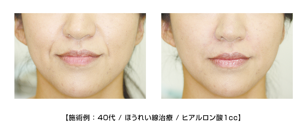 施術例 : 40代 / ほうれい線治療 / ヒアルロン酸1cc