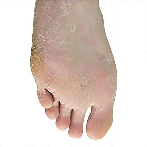 足白癬・水虫