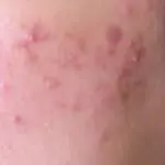 にきび外来