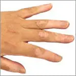 尋常性白斑