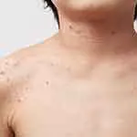 汗疹（あせも）