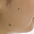 ほくろ
