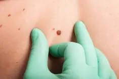 ヒロクリニックほくろ