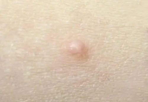 ヒロクリニック水いぼ