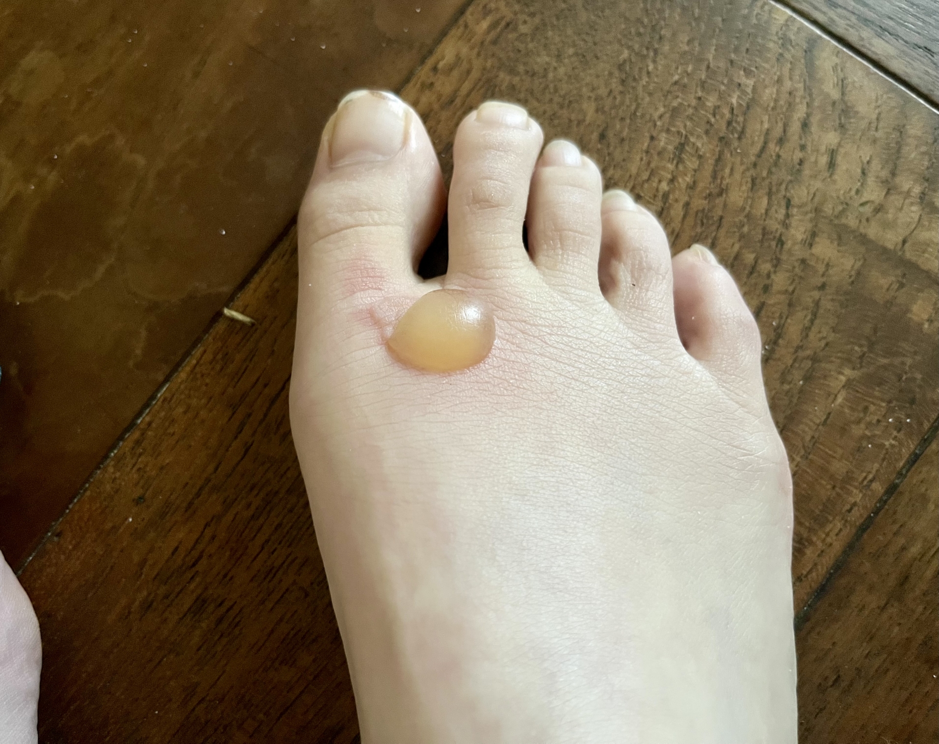 やけどの傷跡を残さない治療法｜形成外科で受ける最新の熱傷ケアとは