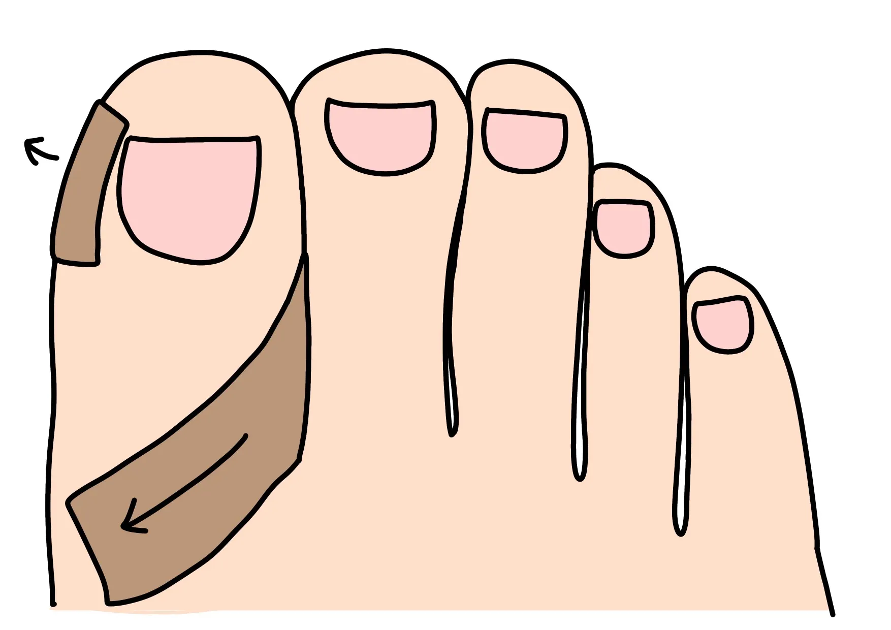 VHO式矯正法 図解