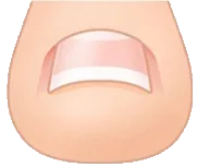 VHO式矯正法 図解