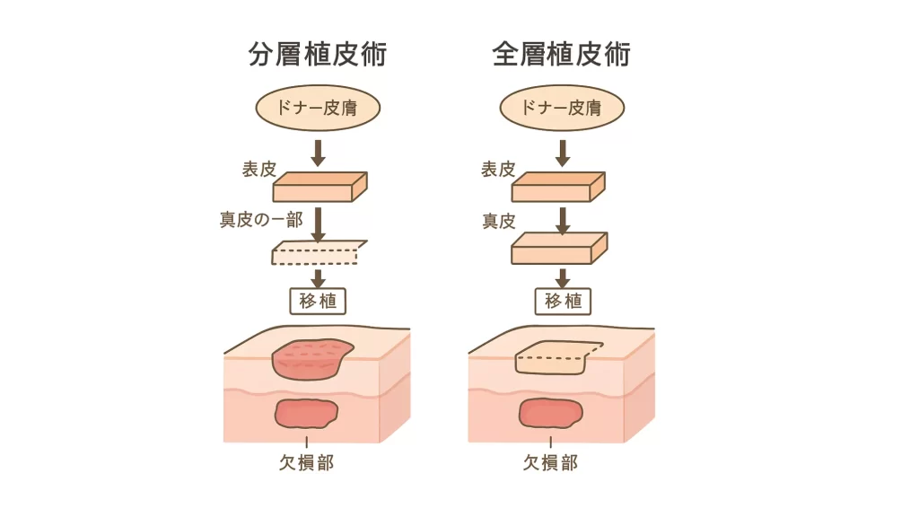 全層植皮術とは?適応症例・手術の流れ・メリットとデメリットを解説【形成外科ガイド】|皮膚科・形成外科の専門治療ならヒロクリニック