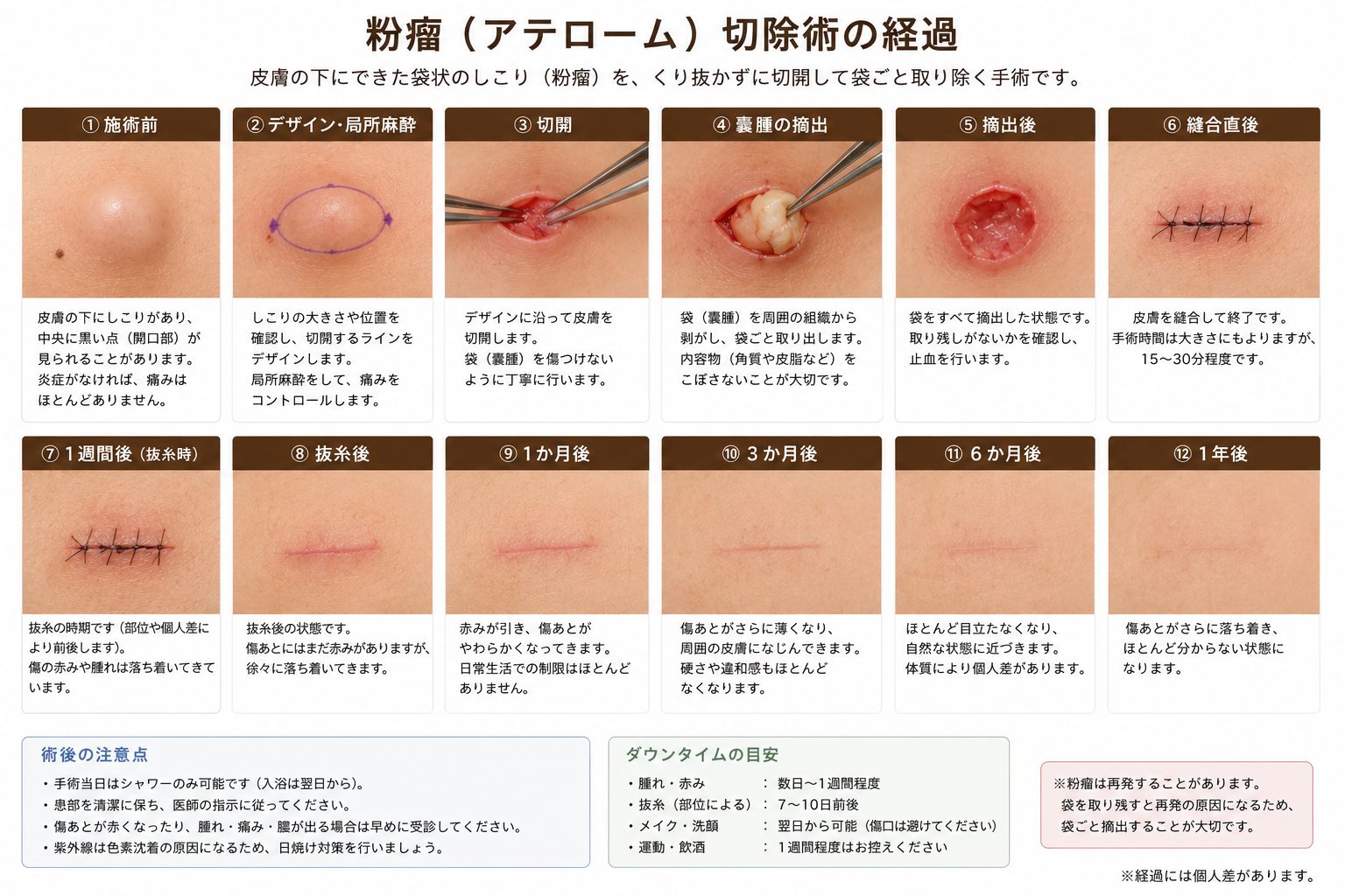 粉瘤（アテローム）切除術の手術ステップ（切開・嚢腫の摘出・縫合）と抜糸後から1年後までの経過