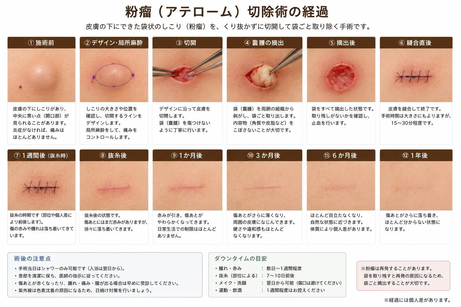 粉瘤（アテローム）切除術の手術ステップ（切開・嚢腫の摘出・縫合）と抜糸後から1年後までの経過