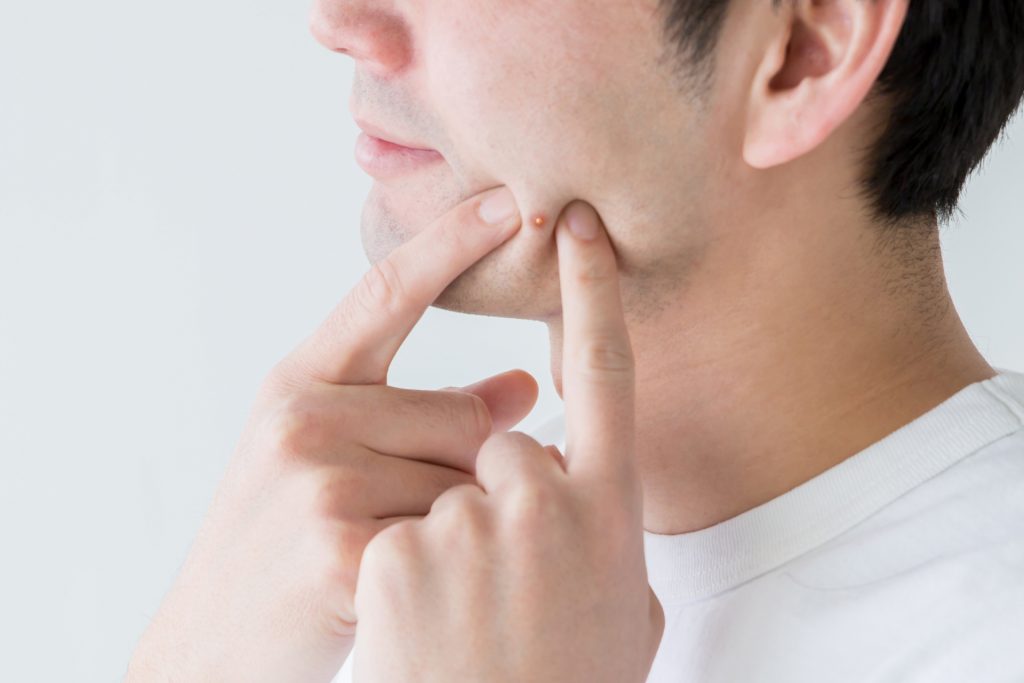 ニキビを潰す男性