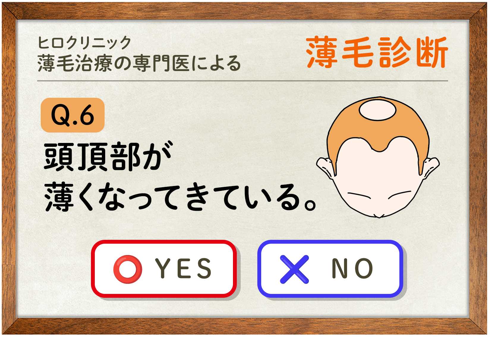 植毛完全ガイド : 世界のスタンダードFUT治療の流れ : 最新版 自毛植毛/FUE法】傷跡が目立たず自然な薄毛治療｜ヒロクリニック