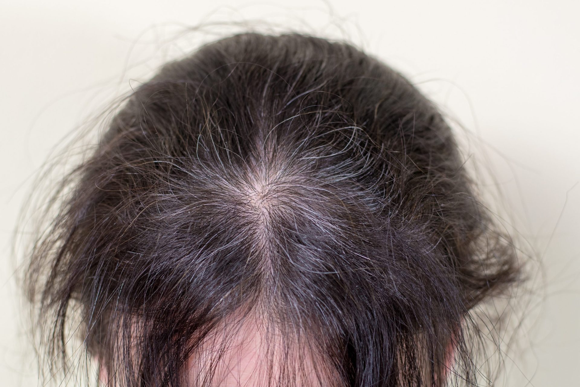 年齢別植毛ガイド：いつが最適なタイミングか？