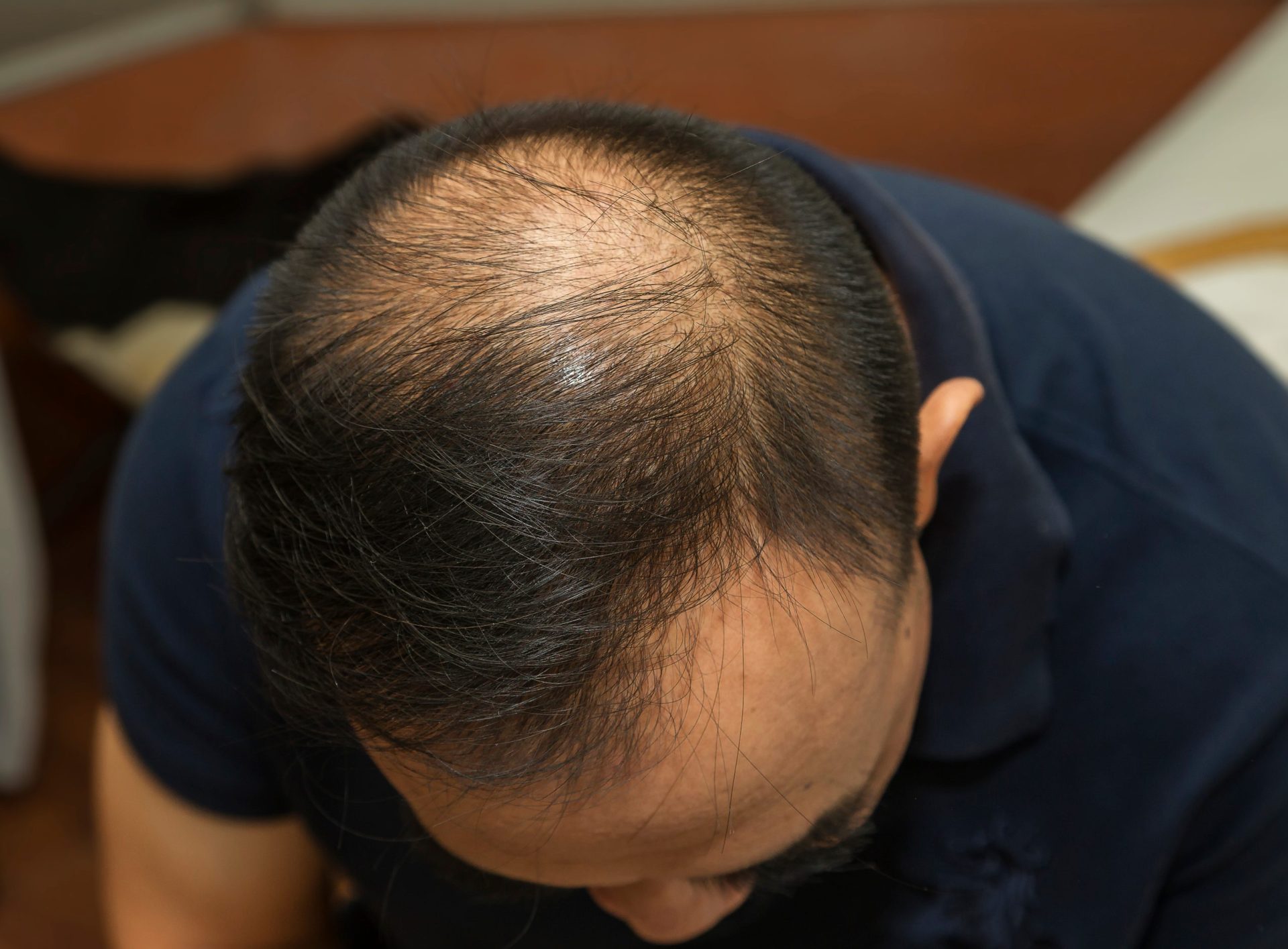 植毛のリスクと利点：治療前に知っておくべきこと