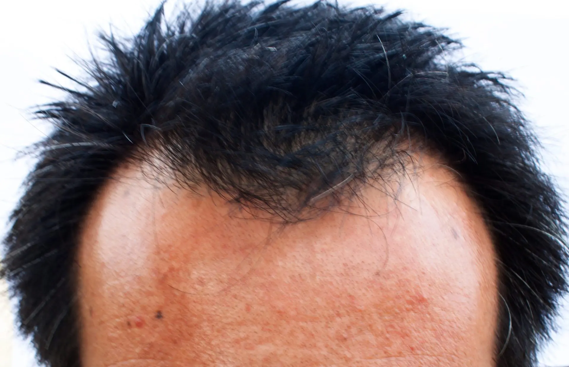 ヒロクリニック植毛｜植毛手術の全プロセス：準備から回復まで