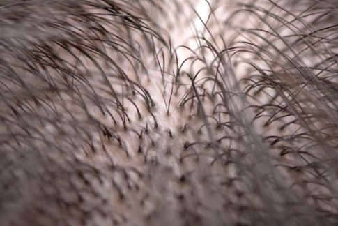 ヒロクリニック植毛|イーロン・マスク(Elon Musk)は植毛した?