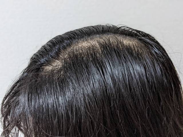 頭頂部の薄毛が進行し、ピンク色の地肌が黒髪に囲まれてはっきりと目立っている男性の頭部。男性型脱毛症（AGA）特有の頭頂部脱毛の進行例を示すイメージ。